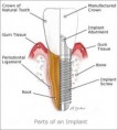 /album/dental-implant/implant-2-jpg/